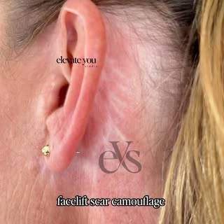 Watch me camouflage tattoo Facelift surgery scar 💕

www.elevateyoustudio.com
Book your appointment 