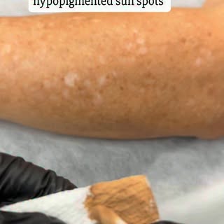 White sun spots (Idiopathic Guttate Hypomelanosis) are Triggered by cumulative UV exposure and aging