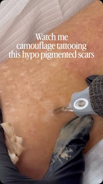 Did you know hypopigmented scars can  be camouflaged with skin tone tattoo pigment?

Scar camouflage