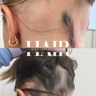 REAL RESULTS, REAL PEOPLE.

At Hair Revive, we’re not just treating hair loss,we’re restoring confid