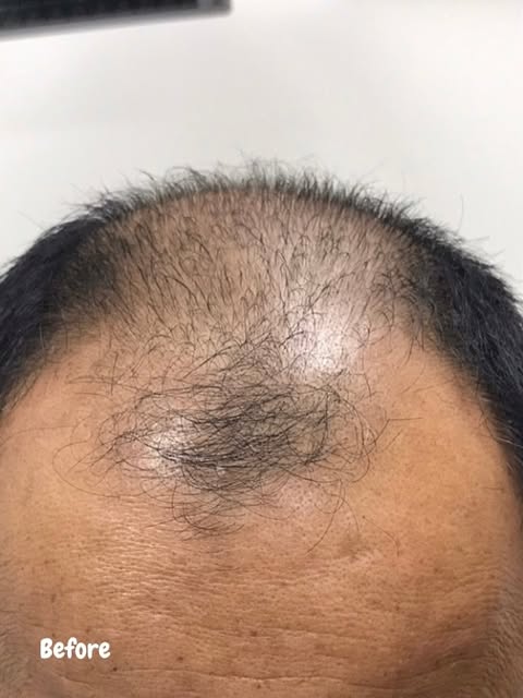 Just weeks between these photos after PRP and Low Level Laser Therapy 👏

A fuller, healthier lookin
