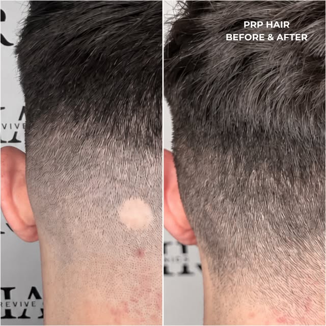 PRP Hair Restoration ✨

These results are just ONE MONTH apart. 🤯

PRP (Platelet-Rich Plasma) uses 