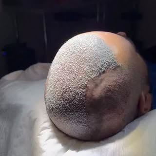 🔥 10.000 Unidades Foliculares 🔥

Un desafío extraordinario.
Un resultado que recién comienza.

Tre