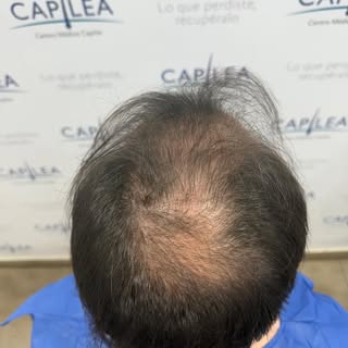 7.000 UF después: recuperando pelo y farmeando aura 🔥😎

#aura #hairtransplant #chile  #hairtransfo