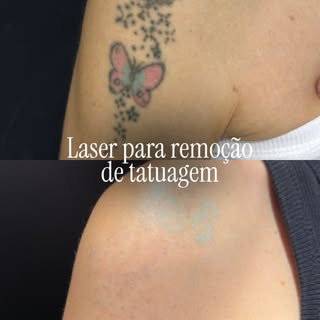 Nem toda tatuagem continua fazendo sentido para sempre. Às vezes, é uma escolha que mudou. Às vezes,
