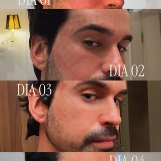 Do procedimento ao glow ✨

O Dr. mostra, na própria pele, como foi a evolução após o Dermablate do m