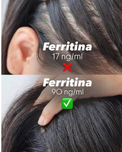 📍 Queda de cabelo nem sempre é apenas genética: deficiências nutricionais também podem contribuir.
