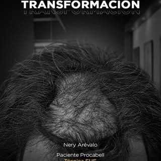 ¡El cambio habla por sí solo! 

Un implante capilar no solo transforma la imagen, también recupera l