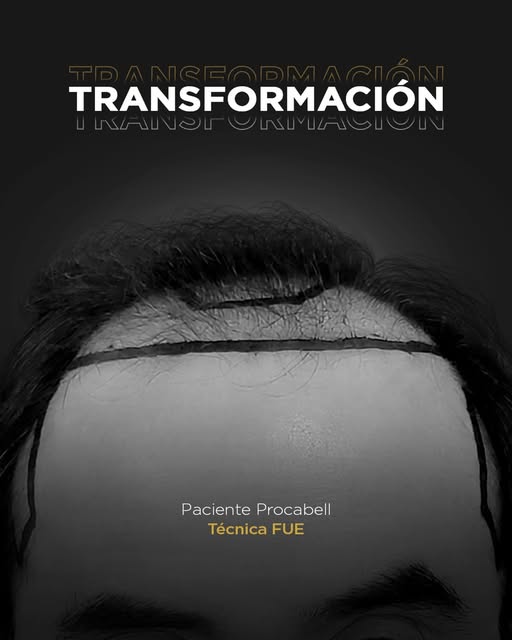 No es solo cabello... ¡es recuperar tu seguridad!
Ver la sonrisa de nuestros pacientes al ver sus re