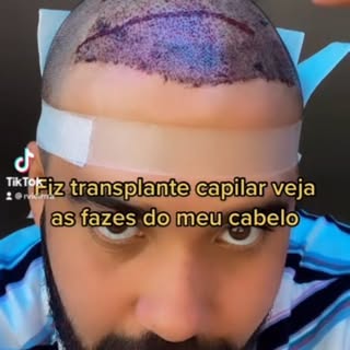 Transplante capilar com 7 meses pós cirurgia! Resultado final com 12 meses. Agende agora mesmo uma a