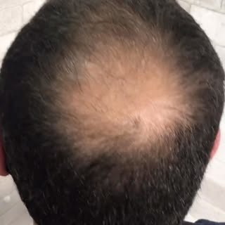A coroa 👑 é a parte que mais incomoda os queridões com queda de cabelo… mas aqui na Newhead a soluç