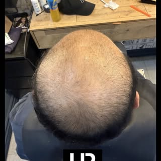 Thinning at a young age can really knock your confidence.

And while a hair transplant might feel li