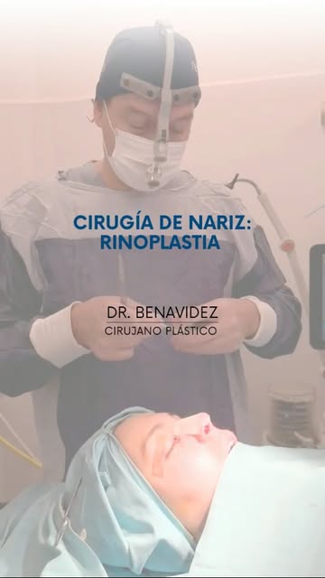 Rinoplastia👉recién terminamos esta cirugía de nariz y estoy muy conforme con el procedimiento. Sali