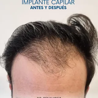✨Resultados reales, resultados naturales: Antes vs. Después 

La clave de un buen implante capilar e