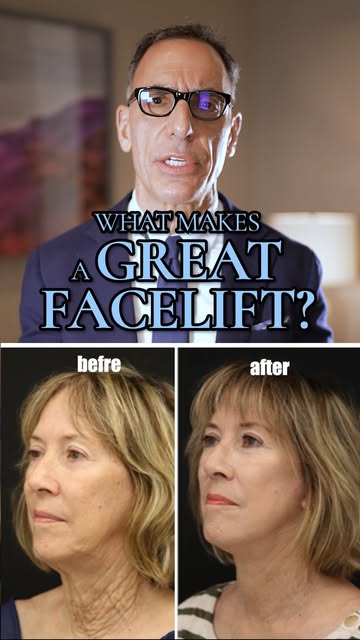 What makes a great facelift?

It's not just lifting the face, it's not tightening the skin.

I liken