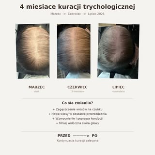 Kilka lat pracy nad terapia dla ciężkich przypadków AGA. 
Dual Track ❤️ w moim gabinecie ❤️ I takie 