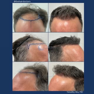 ✨ Amazing results! ✨

This patient underwent a Hybrid FUE procedure, with 2,516 follicular units tra