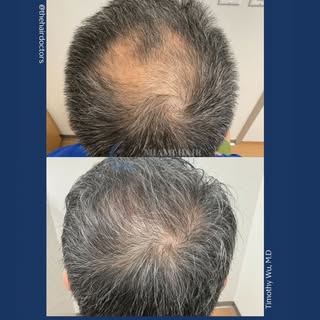 Just 6 months in and the results are amazing! ✨ This patient underwent a manual FUE procedure, with 