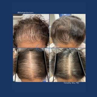 PRP with ACell monotherapy ✨

Results just at 6 months and already looking amazing. Improved thickne