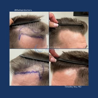 Amazing results achieved with Hybrid FUE ✨

1,887 follicular units transplanted and this is just at 