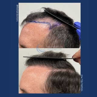 Amazing results 😌

Achieved with Hybrid FUE using 2,312 follicular units for a natural, fuller hair