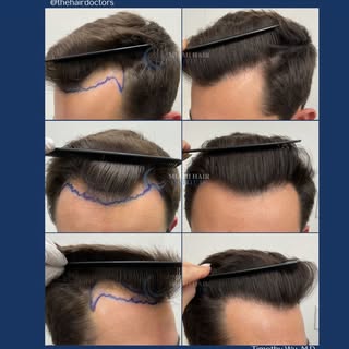 Amazing results with a hybrid hair transplant procedure! 

1,706 follicular units were carefully tra