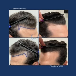 Amazing results from this hybrid hair transplant procedure. A total of 1,715 follicular units were c