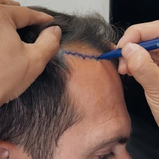 Hairline design with Dr. Wu 

One of the most crucial steps in a hair transplant is creating a hairl