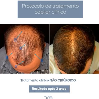 Protocolos clínicos para calvície masculina e feminina. NÃO CIRURGICOS.

O tratamento da alopecia é 