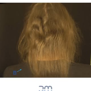 Meu cabelo não cresce???
Queixa muito comum no consultório, como no caso acima. Paciente há vários a