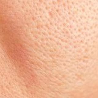 ✨ Say Goodbye to Open Pores! ✨

Struggling with visible open pores that affect your skin’s smooth ap