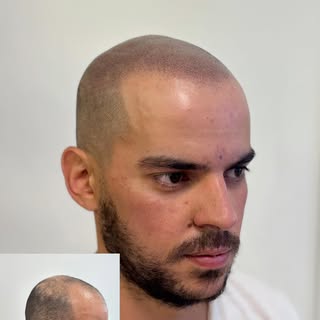 Tratamiento de alopecia areata finalizado, un buen cambio para nuestro cliente, 👌🏼🫡✍🏼