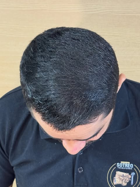 Mais um caso. Transplante capilar com naturalidade no desenho e linha frontal extremamente densa e n