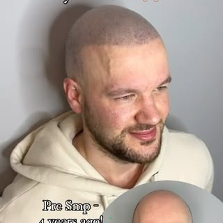 Transform your appearance with Scalp Micropigmentation 🙌🏼

Offering 30% off the full treatment for