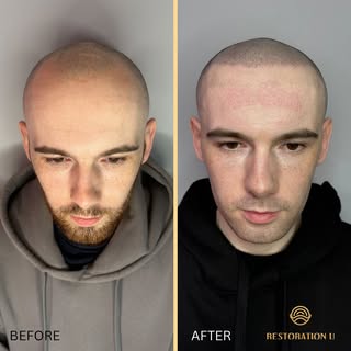 RESULTS 👌🏻⏩️⏩️ from a recent hairline restoration using SMP @restorationu_ 

We help hundreds of p