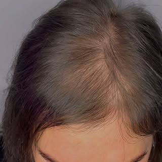 Scalp Micropigmentation is the ideal solution to anyone with thinning hair and visible scalp. 

It’s