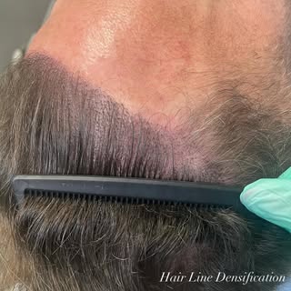 Restore your hair line with Scalp Micropigmentation! 

Are you worried about your thinning hair and 