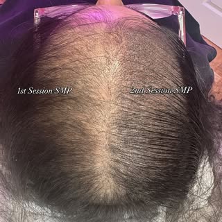 Half way through 2nd session female Scalp Micropigmentation 👌🏼

SMP is very natural and looks just