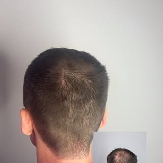 Same guy. Same month 🤯

That’s Scalp Micropigmentation - no surgery, no recovery, no “give it six m
