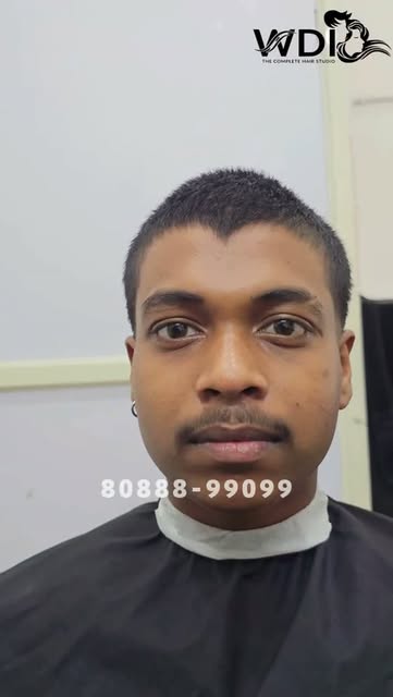 From hair thinning and bald areas to a completely refreshed hairstyle!
Sometimes, even when you have