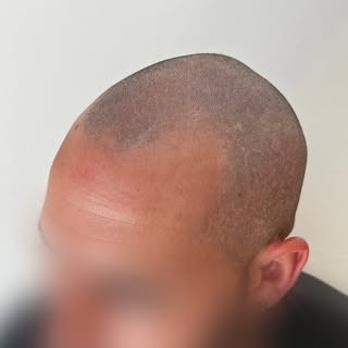 •Ricostruzione Hairline• 
🖤
Contattami per la tua consulenza gratuita 
📲3488618352
📩mntricopigmen