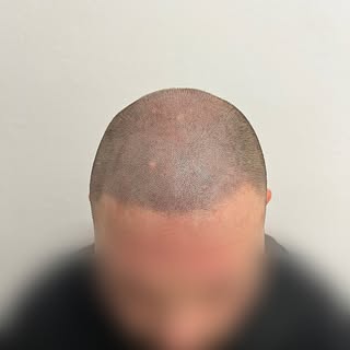 •Infoltimento• 
🖤Scorri per vedere il prima🖤
Contattami per la tua consulenza gratuita, anche tram