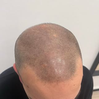 •TRICOPIGMENTAZIONE•
Infoltimento 🖤 Scorri per vedere il prima e dopo ➡️

Contattami per la tua con