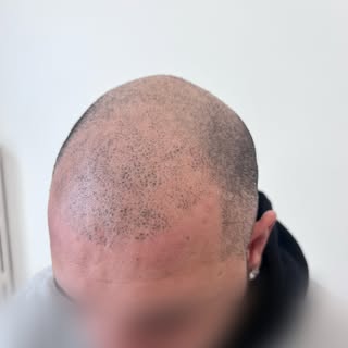 ❌Correzione Tricopigmentazione eseguita da un altro operatore❌
La prima foto è dopo che il cliente s
