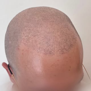 •TRICOPIGMENTAZIONE•
Infoltimento post Autotrapianto 🖤 Scorri per vedere il risultato ➡️

Contattam