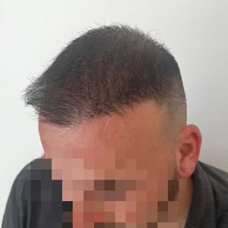•Infoltimento Uomo•
Scorri per vedere il prima 🖤
Contattami per la tua consulenza gratuita. 
Anche 