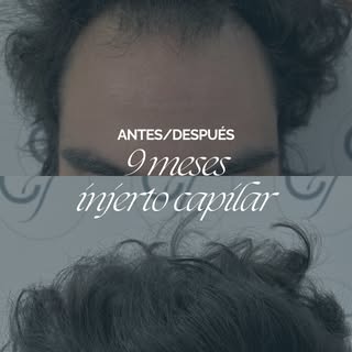 9 meses de transformación ✨

Una línea frontal muy difusa cuyo resultado pasa a ser un cabello lleno
