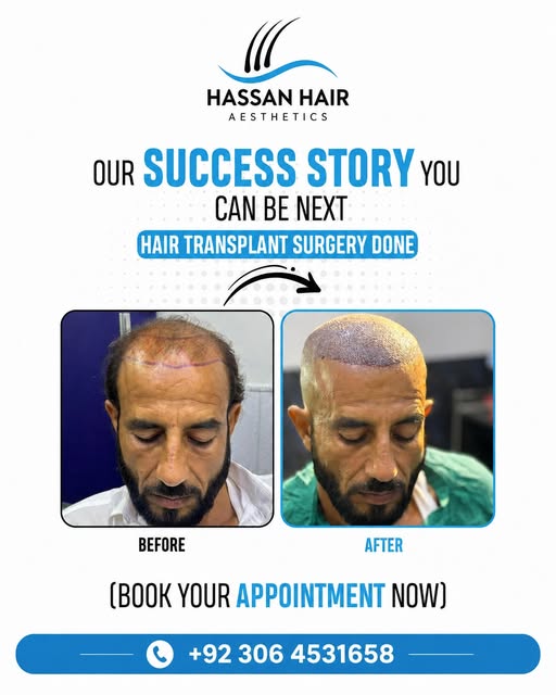 🦱 Hair Transplant – Real Results, Real Confidence

Our Success Story — You Can Be Next!
Get natural