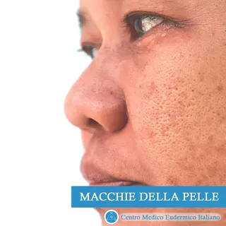 Le macchie sulla pelle - cosa sono, perchè si formano e come rimuoverle. Scorri le foto per scoprire