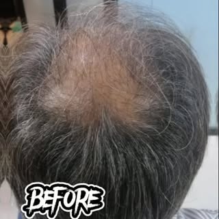 A quick glimpse into the hair transplant journey ✨
#explore #pakistan #HairClinic #BeforeAndAfter #C